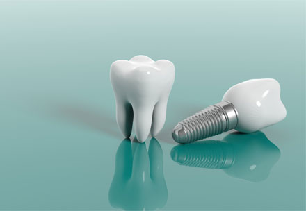 Symbolbild das einen Zahn neben einem Implantat zeigt