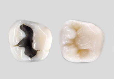 Zwei Zähne nebeneinander. Links dunkles Amalgam, rechts eine Kunststoffüllung bei welcher der Unterschied zum Zahn nicht sichtbar ist.