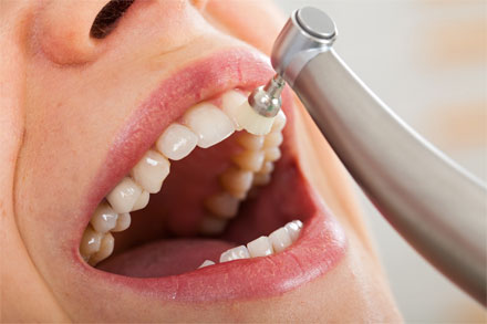 Politur der Vorderzähne mittels Bürste im Rahmen der Mundhygiene